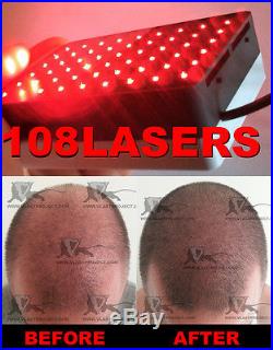 108 Lasers! Hair Loss Growth Treatment The Ultimate Hair Regrowth