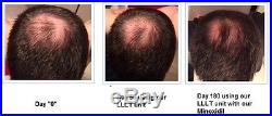108 Lasers! Hair Loss Growth Treatment The Ultimate Hair Regrowth