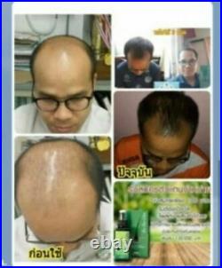 10 x 4oz. Neo Hair Lotion Growth Root Hair Loss Treatments beards sideburns