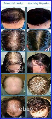 2023 USPro 82 diodes Laser Cap Hair growth / regrowth, Hair loss, FDA cleared