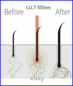 FDA Cleared Hair Regrowth Laser Cap 81 Diodes LLLT Helmet / Hair Loss Treatment