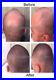 Ginseng Natural Hair Loss Treatment Unisex Fast Growth Regrowth DHT Blocker NEW