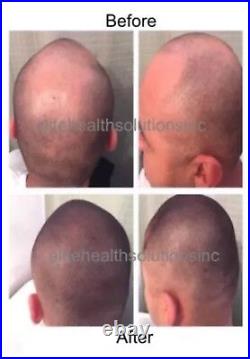 Ginseng Natural Hair Loss Treatment Unisex Fast Growth Regrowth DHT Blocker NEW