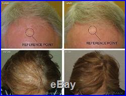 HairMax Laserband 41 Hair Regrowth Laser Device