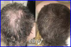 Hair GROWTH Treatment From MiraGrowth