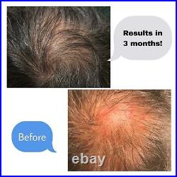 Hair GROWTH Treatment From MiraGrowth