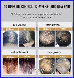 Laser CAP 272 diodes, hair regrowth, hair loss, hair growth, FDA cleared