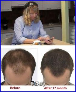 Laser Cap 272 FDA Cleared Hair Loss Treatmen Balding Thinning Regrow Men & Woman