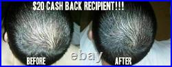 Laser Comb Hair Growth Loss Promoter Regrowth (28x More Power Than Other Lasers)