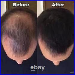 PRO Hair Growth Laser Helmet LED Hair Loss Regrowth Helmet For Thinning Hair
