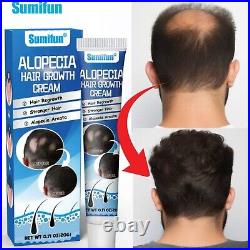 Sumifun Alopecia Treatment Cream Hair Growing Prevent Alopecia Baldness Regrowth