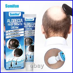 Sumifun Alopecia Treatment Cream Hair Growing Prevent Alopecia Baldness Regrowth