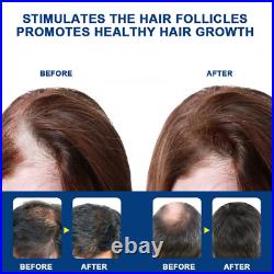 Sumifun Alopecia Treatment Cream Hair Growing Prevent Alopecia Baldness Regrowth